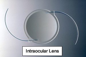 IOL-300x202