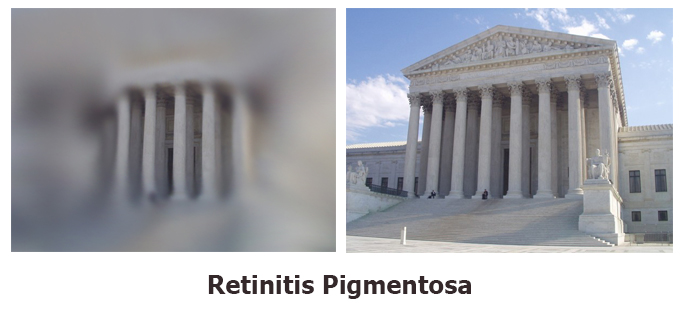 Retinitis Pigmentosa