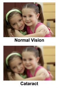 cataract-1-199x300