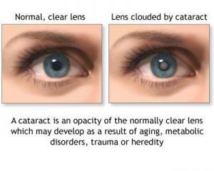 cataract-picture-c-300x240