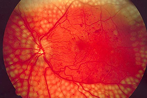 DiabeticFundusOttica